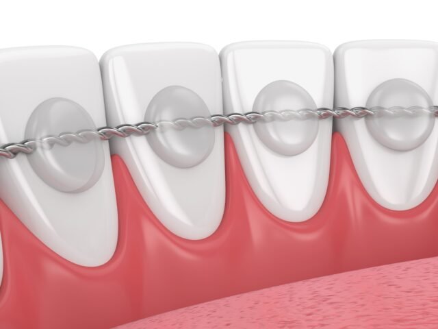 traitement de contention orthodontie